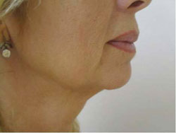 Face after treatment with Accent