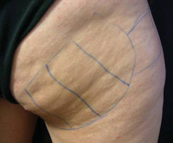 Cellulite before treatment