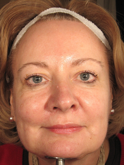 After Treatment with Sculptra