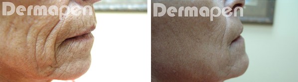 Before and after Dermapen on a womans chin