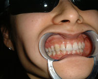 Previous brace wearer corrected after Invisalign treatment
