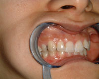 Previous brace wearer before Invisalign treatment