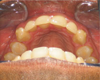 Protruding (buck) teeth corrected after Invisalign treatment