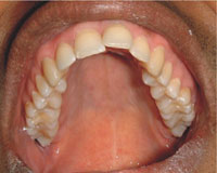 Protruding (buck) teeth before Invisalign treatment