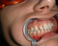 Crooked teeth before Invisalign treatment