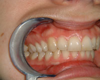 Crowded and overlapping teeth corrected after Invisalign treatment