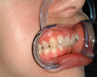 Crowded and overlapping teeth before Invisalign treatment