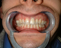 Gappy teeth corrected after Invisalign treatment