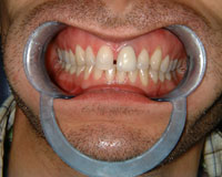 Gappy teeth before Invisalign treatment