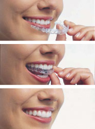 Invisalign Clear Aligners