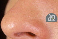 After 2 Milk Peel Treatments for Oily Skin