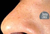 Oily Skin Before Treatment