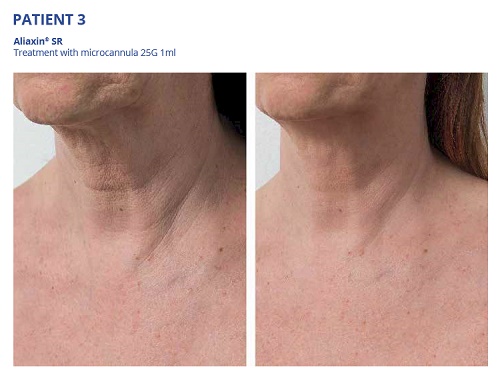 Aliaxin SR Before and After Neck