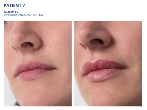Aliaxin FL Before and After Lips