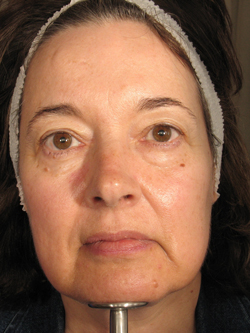 Before Treatment with Sculptra