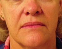 Face before Titan treatment