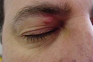 wart on eyelid