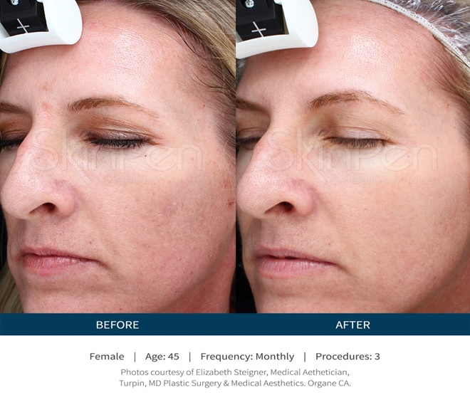 Before and After SkinPen treatment for skin rejuvenation