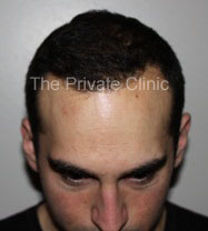 FUE Hair Transplant Result