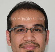 After hair transplantation