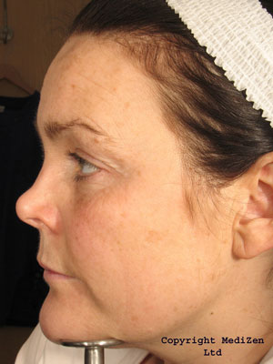 After PIXEL Fractional Resurfacing