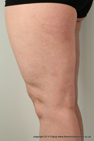 After sclerotherapy treatment on leg veins