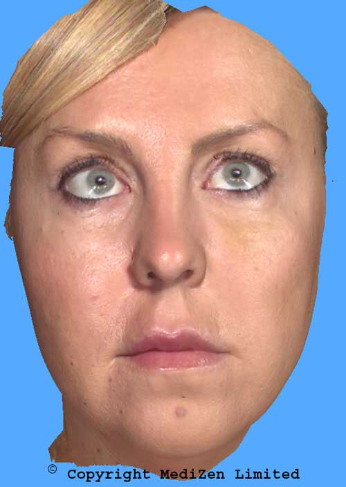 After Restylane SubQ
