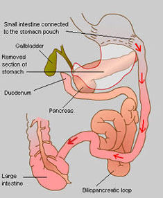 Biliopancreatic Diversion Operation