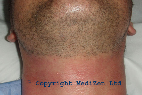 Male beard line after laser hair removal