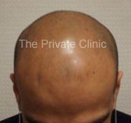 Before hair transplantation