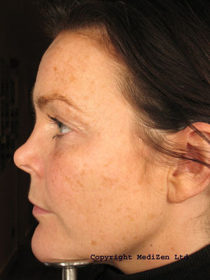 Pigmentation before treatment