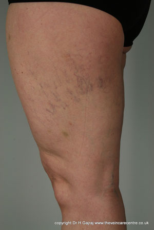 Thread veins in the leg before sclerotherapy