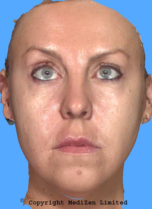 Before Restylane SubQ