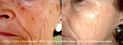 peels glycolic skintech tca lactic phenol hyperpigmentation