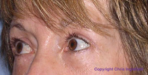 Post Blepharoplasty Surgery