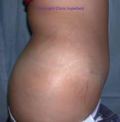 Post Tummy Tuck Surgery Side