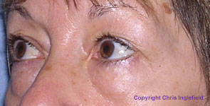 Pre Blepharoplasty Surgery