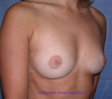 Before Breast Augmentation (Implant) Surgery