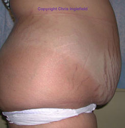 Pre Tummy Tuck Surgery Side