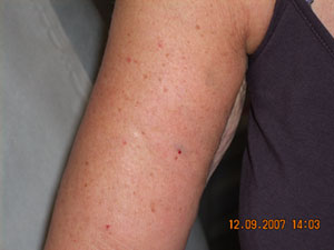 Arm After Carboxytherapy
