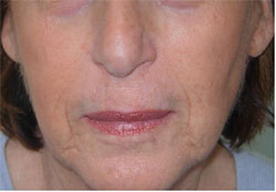 Nasolabial Folds After Carboxytherapy