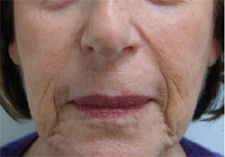 Nasolabial Folds Before Carboxytherapy