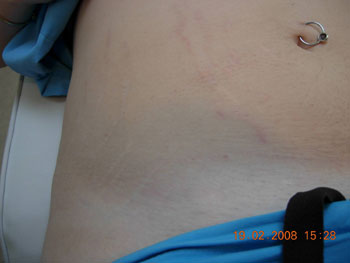 Stretch Marks After Carboxytherapy