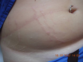 Stretch Marks Before Carboxytherapy