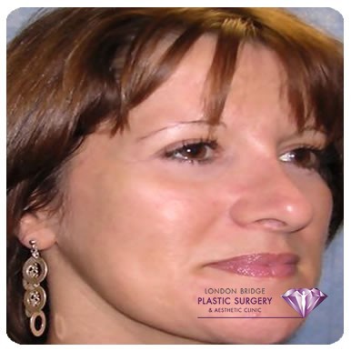 After cheek augmentation