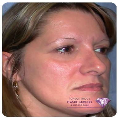 Before cheek augmentation