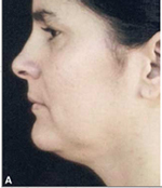 Smart Lipo - Double Chin Before Treatment