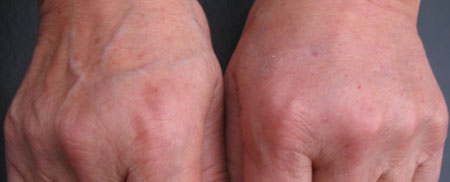 Elastence - Hand Rejuvenation