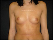 breasts before fat transfer - front view