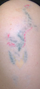 Laser Tattoo Removal - After 5 treatment sessions